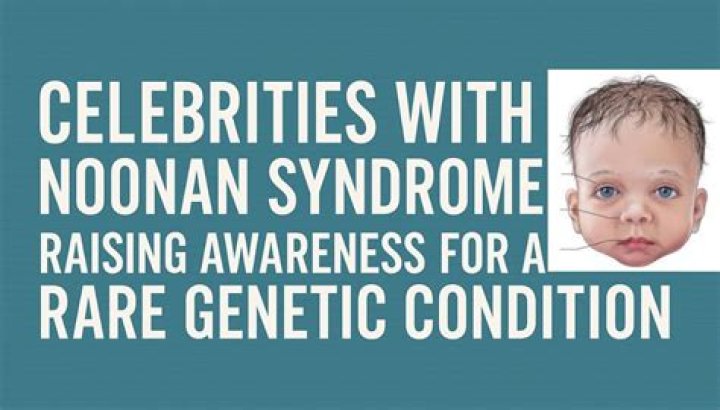The Famous Faces Of Noonan Syndrome