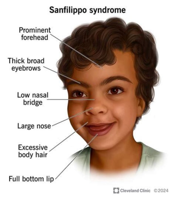 Understanding Sanfilippo Syndrome Through The Lens Of Jonny Lee Miller